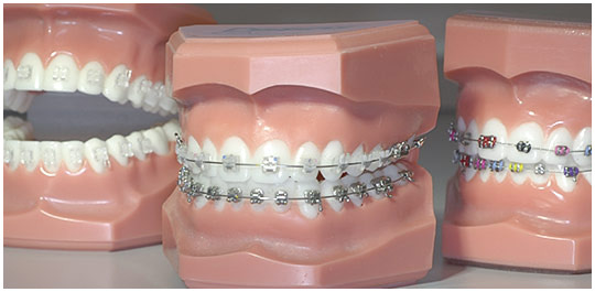 Herausnehmbare Zahnspangen Modelle